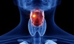 Описано влияние агонистов рецепторов GLP1 на риск развития рака щитовидной железы